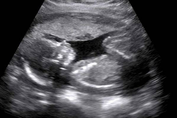 U 9. mjesecu trudnoće obavila ultrazvuk, doktori nisu mogli da vjeruju šta ”vide”!