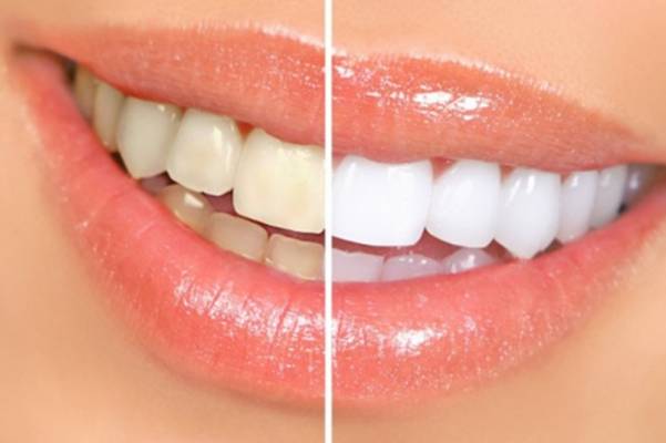 POTREBNA 2 SASTOJKA: Izbijelite prirodno zube za samo jednu minutu…