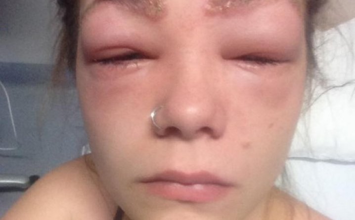 SUTRA MOŽETE BITI VI Djevojka gotovo oslijepila zbog kozmetike: Vrištala sam od bolova!