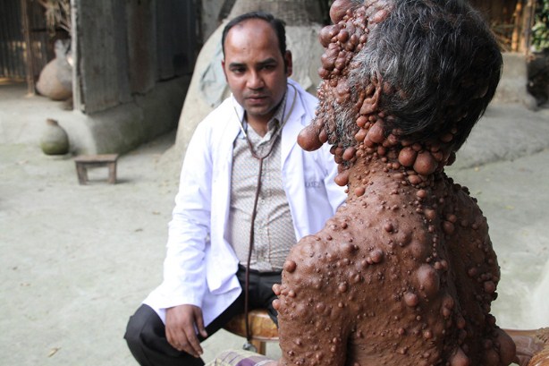 Užasan genetski poremećaj: Muškarac iz Bangladeša na tijelu ima stotine tumora, rođeni sin ga se plaši VIDEO.