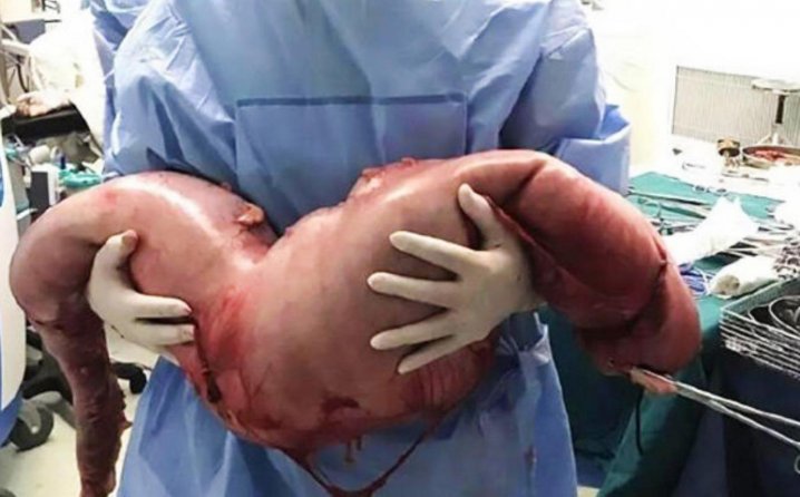 Doktori tokom operacije povraćali: Iz mladića izvadili užas težak 13 kilograma