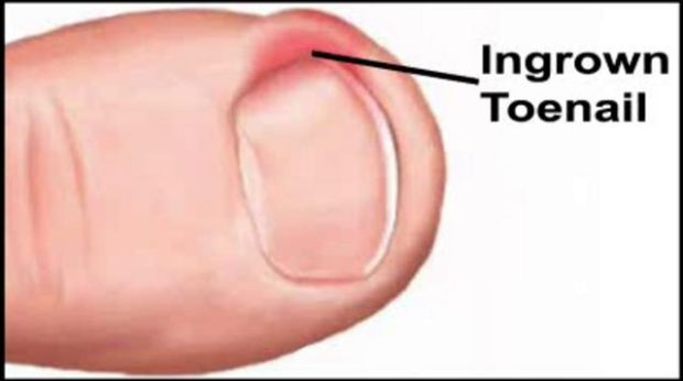 Kako se riješiti uraslog nokta bez odlaska ljekaru