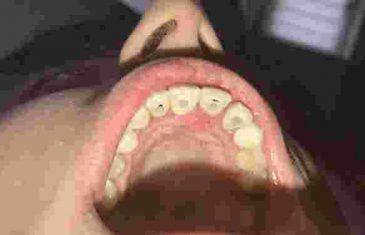 IMATE GA U KUHINJI: Samo jednim sastojkom riješite se zubnog kamenca, plaka i bakterija!