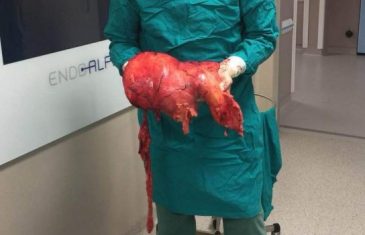 Veliki poduhvat ljekara KCUS-a: Pacijentici odstranjen tumor od 11,4 kilograma, operacija trajala šest i po sati!